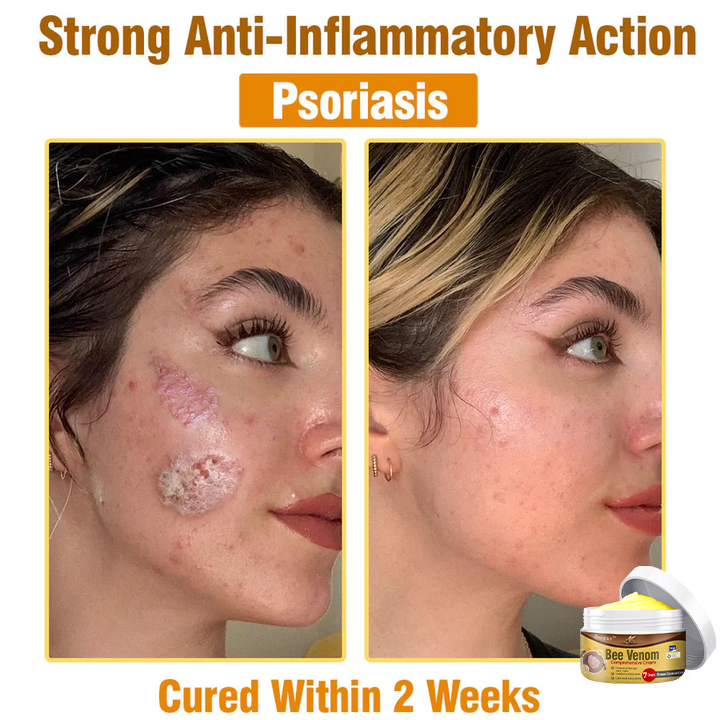 👩 Tnnedey™ Bee Venom Comprehensive Cream 🇬🇧 Dermatologist Approved
