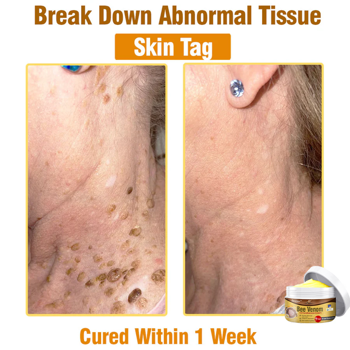 👩 Tnnedey™ Bee Venom Comprehensive Cream 🇬🇧 Dermatologist Approved