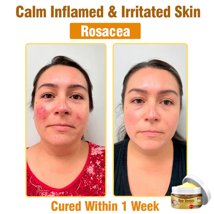👩 Tnnedey™ Bee Venom Comprehensive Cream 🇬🇧 Dermatologist Approved