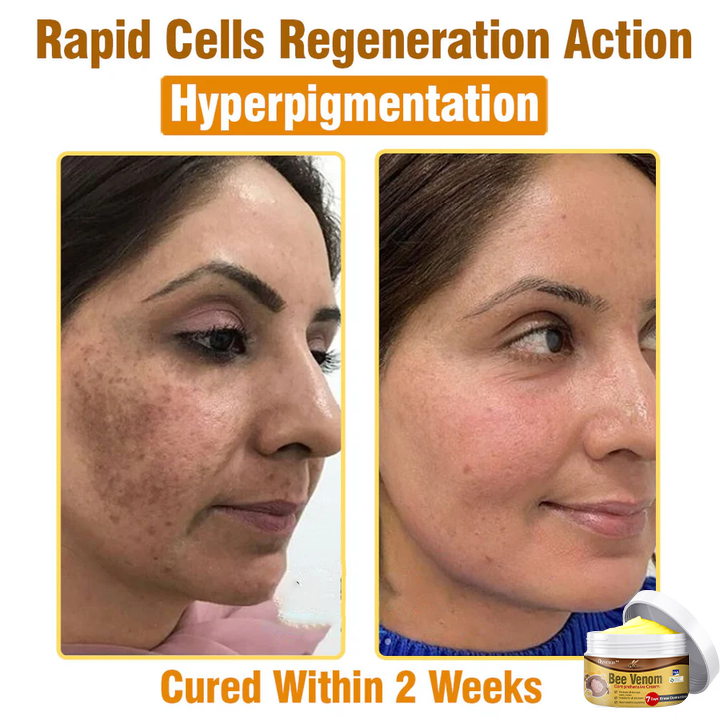 👩 Tnnedey™ Bee Venom Comprehensive Cream 🇬🇧 Dermatologist Approved