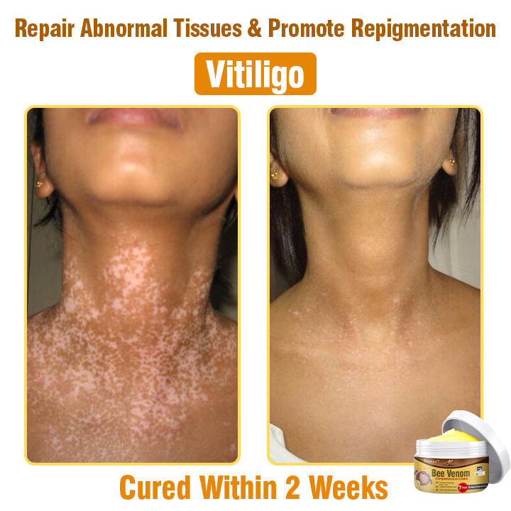 👩 Tnnedey™ Bee Venom Comprehensive Cream 🇬🇧 Dermatologist Approved