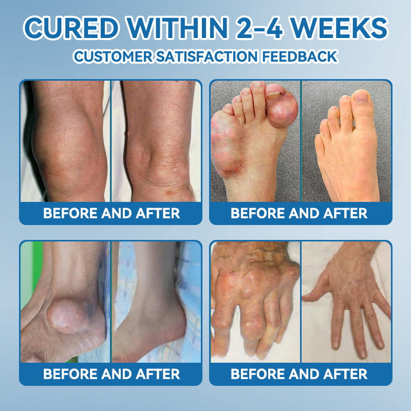 【𝐅𝐢𝐧𝐚𝐥 𝐃𝐚𝐲 – 𝟕𝟎% 𝐎𝐅𝐅】💙 Tnnedey® BPC-157 Joint Healing Cream🦴Treats Arthritis, Neuropathy, Rheumatism, Sports Injuries & More💪