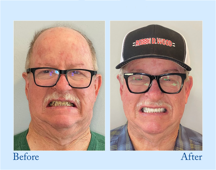 HEATWOLF® - Premium Customized Full Denture Set🦷-The Royal London Dental Hospital accreditation(🍀Limited Time Discount Last 30 Minutes🍀)🍀🍀