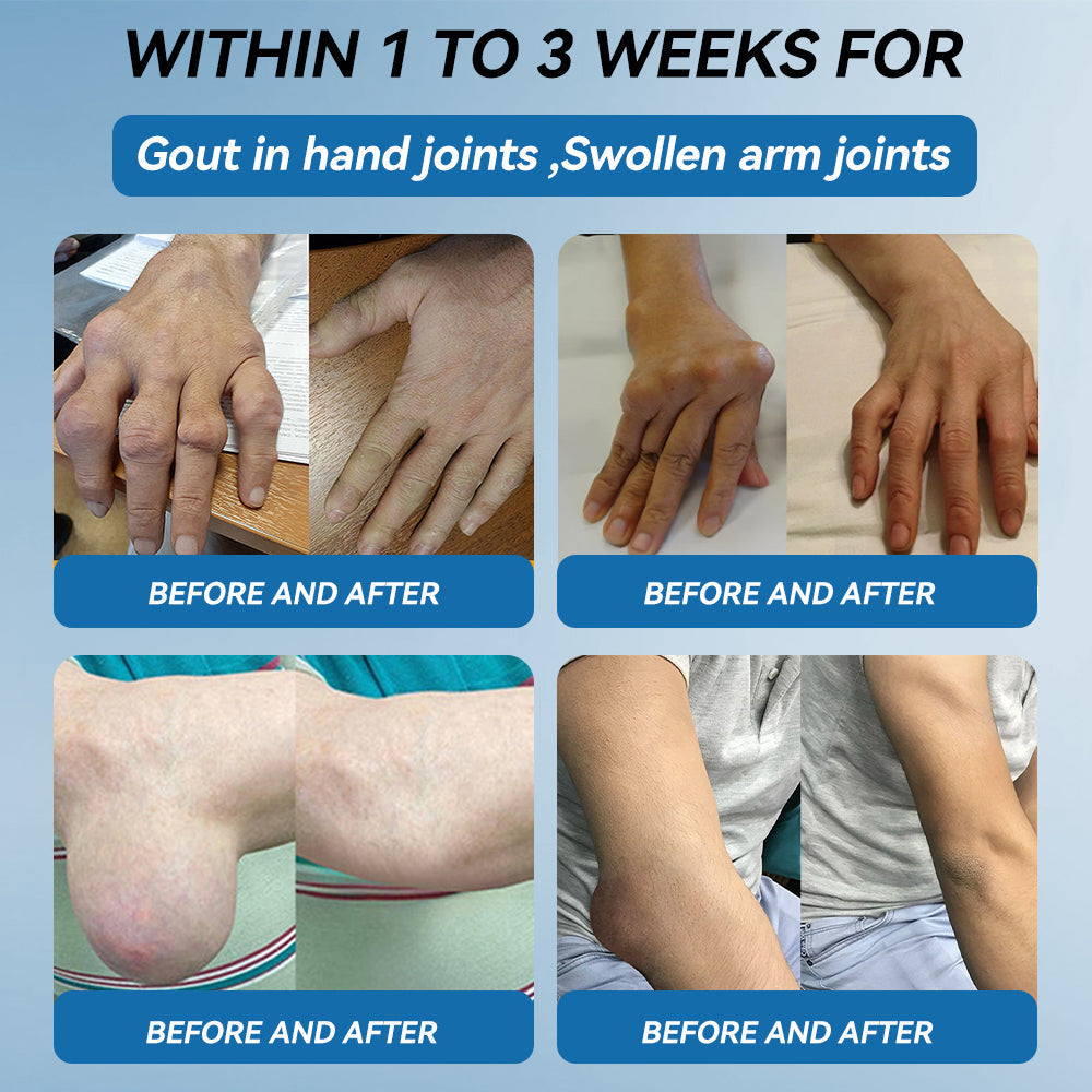 【𝐅𝐢𝐧𝐚𝐥 𝐃𝐚𝐲 – 𝟕𝟎% 𝐎𝐅𝐅】💙 Tnnedey® BPC-157 Joint Healing Cream🦴Treats Arthritis, Neuropathy, Rheumatism, Sports Injuries & More💪