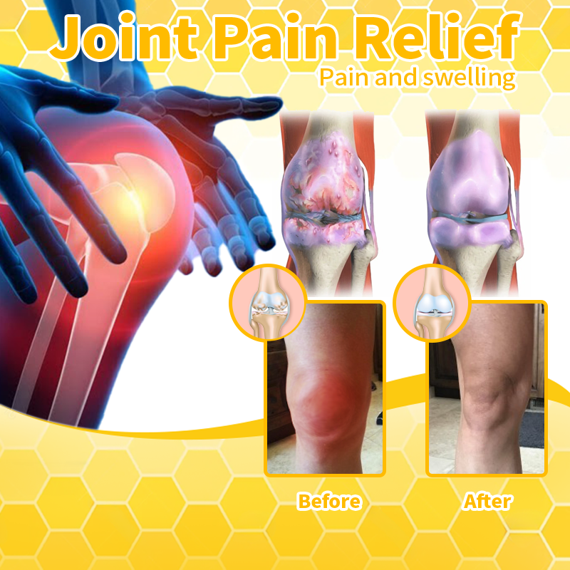 𝐓𝐧𝐧𝐞𝐝𝐞𝐲™ 𝐁𝐞𝐞 𝐕𝐞𝐧𝐨𝐦&𝐓𝐮𝐫𝐦𝐞𝐫𝐢𝐜 𝐀𝐫𝐭𝐡𝐫𝐢𝐭𝐢𝐬 𝐓𝐡𝐞𝐫𝐚𝐩𝐲 𝐂𝐫𝐞𝐚𝐦(👩🔬𝐒𝐩𝐞𝐜𝐢𝐚𝐥𝐢𝐳𝐢𝐧𝐠 𝐢𝐧 𝐨𝐫𝐭𝐡𝐨𝐩𝐞𝐝𝐢𝐜 𝐜𝐨𝐧𝐝𝐢𝐭𝐢𝐨𝐧𝐬 𝐚𝐧𝐝 𝐣𝐨𝐢𝐧𝐭 𝐩𝐚𝐢𝐧👩🔬