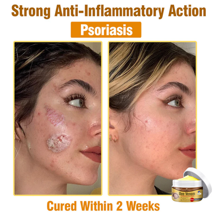 👩 Tnnedey™ Bee Venom Comprehensive Cream 🇬🇧 Dermatologist Approved